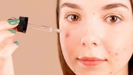 Sí, como bien sabes, algunos cosméticos pueden producir acné, acné cosmético. Y si no lo sabías, te lo vamos a contar todo de esta alteración y cómo tratarla de la mano de toda una experta, la farmacéutica Belén Acero