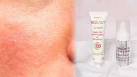 Abril es el mes de la concienciación de la rosácea y el laboratorio farmacéutico lanza un revolucionario tándem perfecto para tratarla