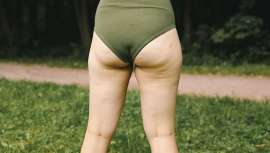 La celulitis, comúnmente conocida como piel de naranja, es una afección cutánea que padecen más las mujeres debido al efecto de hormonas femeninas como los estrógenos, según explica la Dra. Cristina Chacón, experta en medicina estética