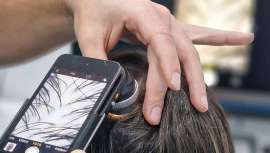 Esta enfermedad, que padecen actualmente alrededor de 40.000 personas en España, provoca una inflamación que normalmente afecta a la piel y al cuero cabelludo, conllevando un deterioro de los folículos pilosos, según explican desde Hospital Capilar