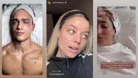 La Generación Z pierde el miedo al acné y recurre a tratamientos naturales para combatirlo 