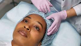 Las infiltraciones de la toxina en la frente para borrar las arrugas del entrecejo pueden influir en cómo procesamos las emociones, según nuevo estudio