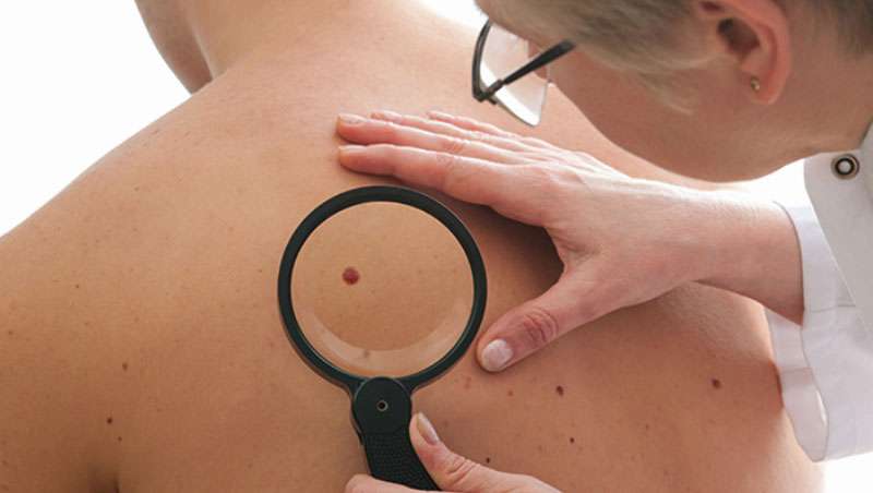 ¿Se curará el cáncer de piel sin cirugía?