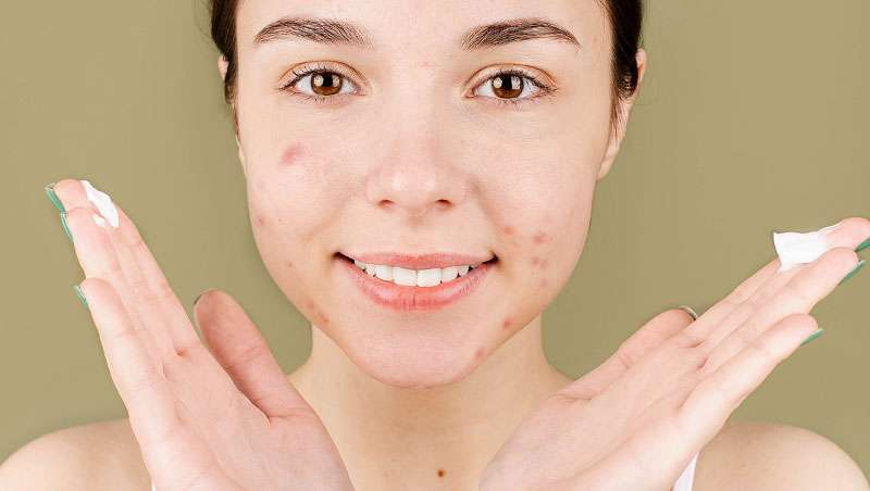 Tipos de acné y cómo tratarlos