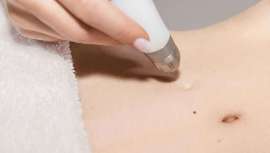 El sistema Dermadrop no solo permite tratamientos para la mejora y rejuvenecimiento de la piel. Con el cartucho Valeophyt nace un nuevo tratamiento terapéutico que alivia el dolor y reduce la inflamación de ligamentos, cápsulas y tendones