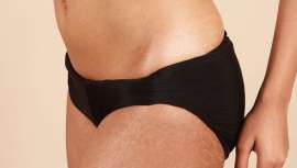 El mejor tratamiento es la prevención, manteniendo la piel sana en su nivel óptimo de hidratación. Pero si ya han aparecido, se pueden tratar con cremas específicas, peelings químicos, láser, microdermoabrasión o dermaroller