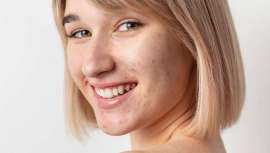 El acné es una afección cutánea común que afecta a personas de todas las edades, pero durante el verano puede convertirse en un desafío adicional