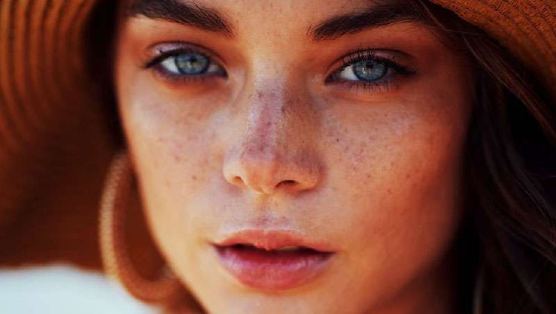 ¿Es posible prevenir las manchas posverano?