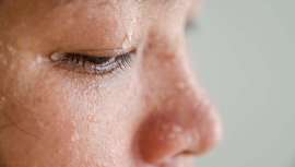 Este problema, que afecta al 3% de la población, hace que se origine una producción anormal o excesiva de sudor en el cuero cabelludo, deslizándose hasta el cuello, las sienes o la frente y aumentando con las altas temperaturas 