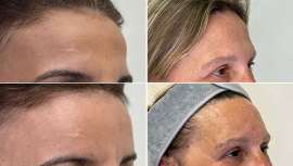 Desde su clínica de Mallorca, la doctora Pupo presenta este novedoso procedimiento, desarrollado en sus espacios de Palma y Madrid, que logra rejuvenecer y armonizar el rostro y eliminar la profusión de sombras que aparecen con el paso del tiempo