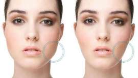 La Bichectomía Química del Dr. Luis López Tallaj, ofrece una alternativa no quirúrgica  para eliminarlas de forma permanente, en 5 minutos y sin someterse a una intervención