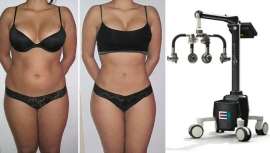 El antídoto contra la retención y grasa acumulada, no invasiva, que asegura la pérdida de peso y talla en tiempo récord 