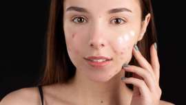 Hablamos de acné digestivo para hablar del acné que se manifiesta junto a síntomas gastrointestinales. ¿Cómo explicarlo y cómo mitigarlo? Hacemos balance con la farmacéutica Belén Acero, especialista en dermofarmacia y nutrición