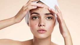 Es habitual la proliferación de granitos tras la época estival. Te enseñamos cómo mantenerlos a raya con los consejos y tratamientos más efectivos