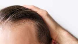 Cuando la dihidrotestosterona (DHT) comienza a circular por el cuerpo, el ciclo de crecimiento de los folículos pilosos se ve afectado y la estructura folicular se satura y recibe menos irrigación sanguínea, dando lugar a la alopecia androgénica