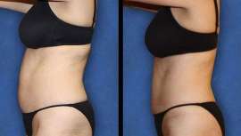 El láser frío de baja intensidad Zerona garantiza la ausencia total de dolor, así como ningún periodo de posoperatorio