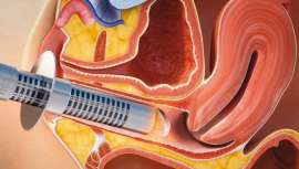 El procedimiento MonaLisa Touch, de Deka, es seguro y eficaz, mínimamente invasivo, para solventar problemas y patologías que afectan a la salud íntima de la mujer, y además está de aniversario. La periodista Mariló Montero cuenta su experiencia