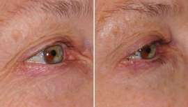 Experta en el manejo de la radiofrecuencia monopolar no invasiva desde hace diez años, la doctora Adriana Ribé, médico y dermatóloga, habla de los resultados de esta técnica en párpados