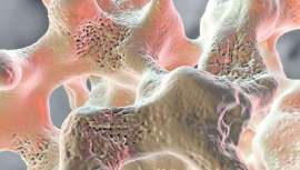 En el marco del Día Mundial de la Osteoporosis, que se celebra el 20 de octubre, ANIS y la Agencia Raíz han organizado un debate en el que se han analizado las claves para crear conciencia acerca del desconocimiento que hay sobre esta enfermedad