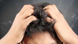 La psoriasis se encuentra asociada a un desajuste en el sistema de defensa del organismo, ya que el propio sistema inmunitario del cuerpo ataca por equivocación al tejido corporal sano, inflamándolo o destruyéndolo, según explica Hospital Capilar