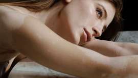 Aunque benigna, la decoloración puede tener un impacto negativo en la calidad de vida de las personas. ¿A qué edad aparece el vitíligo? ¿Podemos tratarlo? Te lo contamos con la ayuda de la Dra. Arantxa Arana, dermatóloga de la Clínica Pérez Sevilla