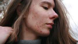 La experta nos ofrece en exclusiva su estudio de la piel y algunos consejos y medidas que pueden ayudar a combatir el acné en esta época del año