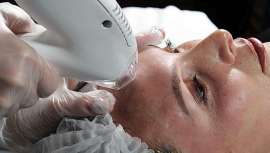 Tixel® llega para revolucionar el sector de la medicina estética con su nueva tecnología patentada, la ablación termo-mecánica (TMA®)