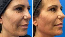 El Dr. Ángel Martín presenta un nuevo abordaje sin cirugía, para rejuvenecimiento de cuello y papada, con la nueva generación de Bioestimuladores de colágeno y Ácido Hialurónico ultrapuro