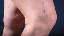 Los doctores Lisbona y Puncernau, directores de la Unidad de Cirugía Láser de Varices, recomiendan tratar las varices y las pequeñas arañas vasculares los primeros meses del año para poder lucir unas piernas perfectas cuando llegue el calor