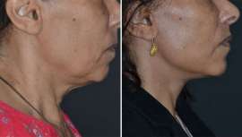 Una de las técnicas más innovadoras en Cirugía Plástica