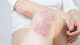 Bristol Myers Squibb (BMS) presenta su compromiso con la investigación en el campo de la inmunología y, en concreto, en el área de la dermatología durante el IX Congreso de Psoriasis de la Academia Española de Dermatología y Venereología en París