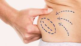 En-Modeling reactiva el metabolismo e incrementa la producción de colágeno y elastina consiguiendo una reducción de volumen desde la primera sesión