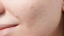 Revisamos qué tipo de cicatrices existen y cómo eliminarlas de la mano de prestigioso Instituto Médico Ricart