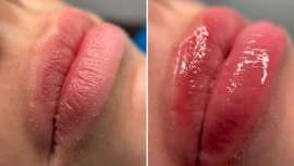 Los labios soñados, pero sin pinchazos 