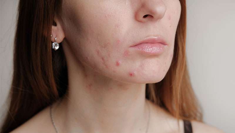 Cómo tratar el acné según las últimas directrices de la Academia Estadounidense de Dermatología