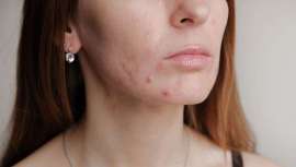 Podría ser necesaria una combinación de tratamientos para controlar el acné problemático en adolescentes y adultos, sugiere la Academia Americana de Dermatología (American Academy of Dermatology, AAD), que enumera 18 recomendaciones al respecto