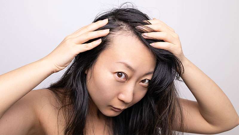 Ataca a la mujer y mucho... Alopecia frontal fibrosante