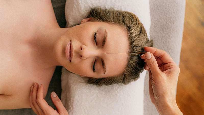 El empleo de la acupuntura en el lifting facial