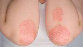 La terapia biológica sistémica puede aumentar la supervivencia de estos pacientes incluso respecto a personas sin psoriasis pero con las mismas enfermedades