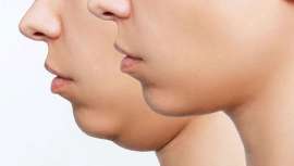 Es importante diferenciar entre doble mentón y papada. El doble mentón se refiere específicamente a la presencia de un pliegue o protuberancia visible debajo del mentón, creando el efecto de tener dos mentones en lugar de uno