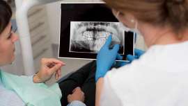 Nuevos implantes que representan una nueva generación de soluciones sin hueso para restaurar la función y estética dental. Nos lo explica Face Clinic