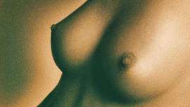 El perfil del implante es la característica que determinará el volumen, la proyección y la forma de la mama