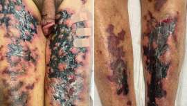 Un artículo de Thomas E. Norman, Alyssa M. Thompson, Andrew Kwong, Maya Hijazi y Scott D. Worswick, perteneciente al simposio de la EADV, publicado en JEADV, biblioteca de consulta, segunda edición