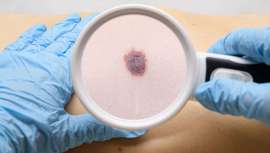 Un artículo del Simposio con los últimos avances científicos e investigaciones en dermatología y venereología de la EADV, cuya próxima cita será del 16 al 18 de mayo en St. Julians, Malta