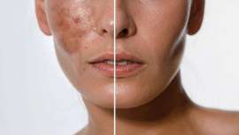 Una innovación LOréal para un tono de piel más uniforme y natural, tratando incluso las marcas más persistentes