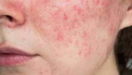 La doctora Trinidad Montero, facultativo especialista del área de Dermatología del Hospital Universitario Virgen de las Nieves de Granada y miembro del CILAD nos explica cómo el cambio de estación afecta a las pieles más sensibles