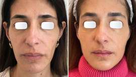 El bioestimulador de colágeno, también llamado Lanluma, está compuesto por ácido poli-L-láctico biocompatible, con una enorme capacidad para estimular la producción de colágeno, dando resultados significativos en la firmeza de la piel