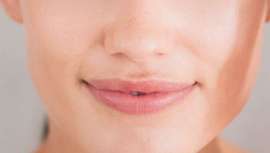 El melasma en el bigote es el tipo de mancha más común. Provocado por el desajuste hormonal y potenciado por el sol, es difícil de disimular, pero existen soluciones para tratarlo