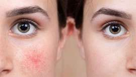 Galderma lanza una nueva campaña este mes de abril con el objetivo de desmitificar todas las falsas creencias sobre esta enfermedad de la piel que afecta a millones de personas