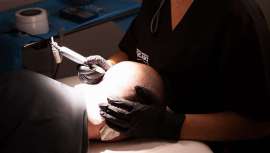 La Dra. Alba Gómez, tricóloga de IMR, nos da las claves de este innovador
sistema de trasplante capilar que evita el rasurado del pelo, reduciendo con creces el impacto emocional de este proceso